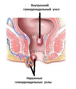 Геморрой причины возникновения у женщин