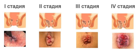 Геморрой причины возникновения у женщин Геморрой причины возникновения у женщин