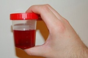 Почему возникает боль, резь и жжение при мочеиспускании у женщин