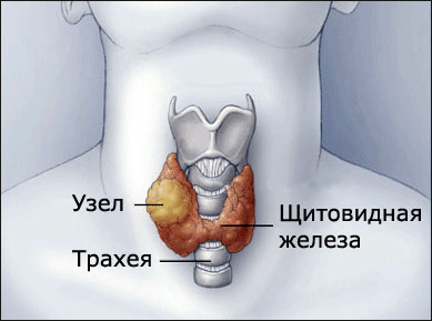 Причины образования узлов щитовидной железы Причины образования узлов щитовидной железы