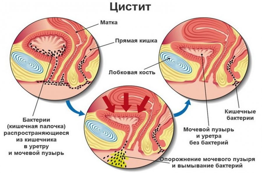 Цистит у женщин симптомы и лечение препаратами и дома Цистит у женщин симптомы и лечение препаратами и дома
